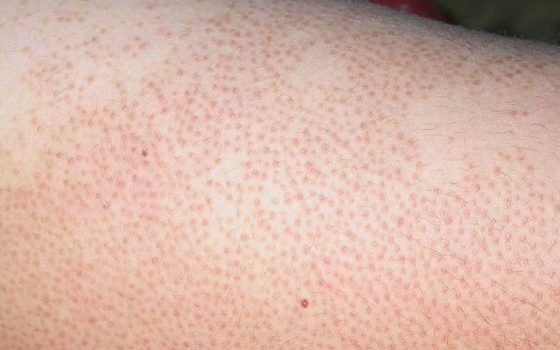 Tìm Serum Trị Viêm Nang Lông Tuệ Châu Vi-Na-Lo Chính Hãng ở đâu? Giá bao nhiêu? Có hiệu quả trị viêm và ngứa như lời đồn?